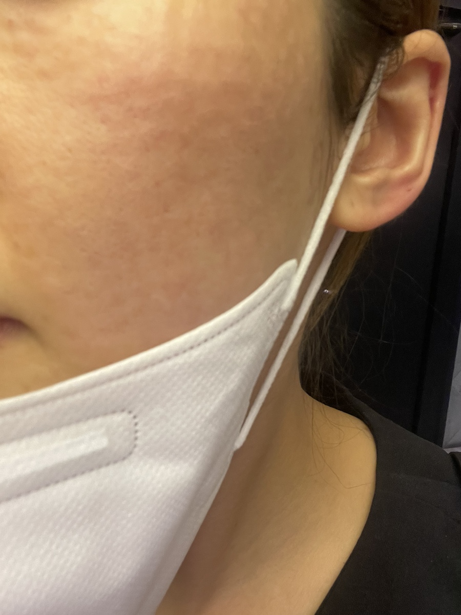 코조각주사 콧볼축소 효과 7