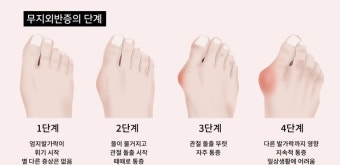 무지외반증 - 7가지 원인과 치료 및 예방 방법