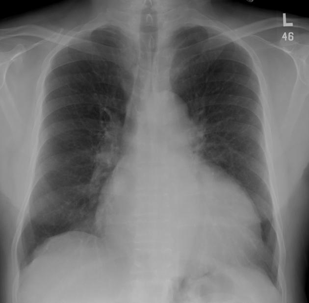 DCMP 의 chest PA : LV dilatation 좌심실 확장 소견이 관찰