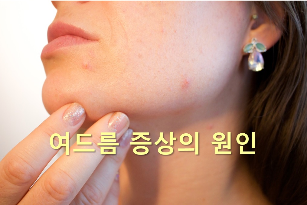  여드름과 지루성피부염의 원인이 다르고 치료 방법도 차이