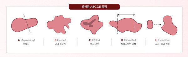 발톱-흑색종-초기-증상-치료-사진