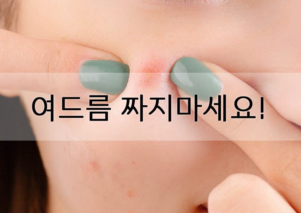  여드름 관리에 좋은 방법들.