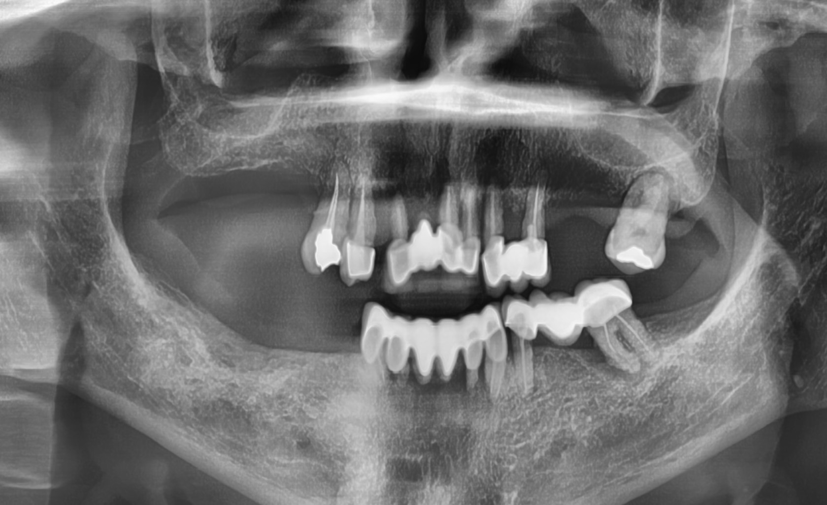 Hong Kong Patient’s Journey to FullMouth Implants in Seoul, South Korea
