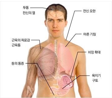 말라리아 증상