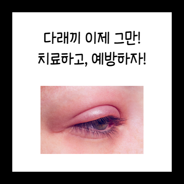  다래끼 이제 그만! 집에서 치료하고, 예방하자!