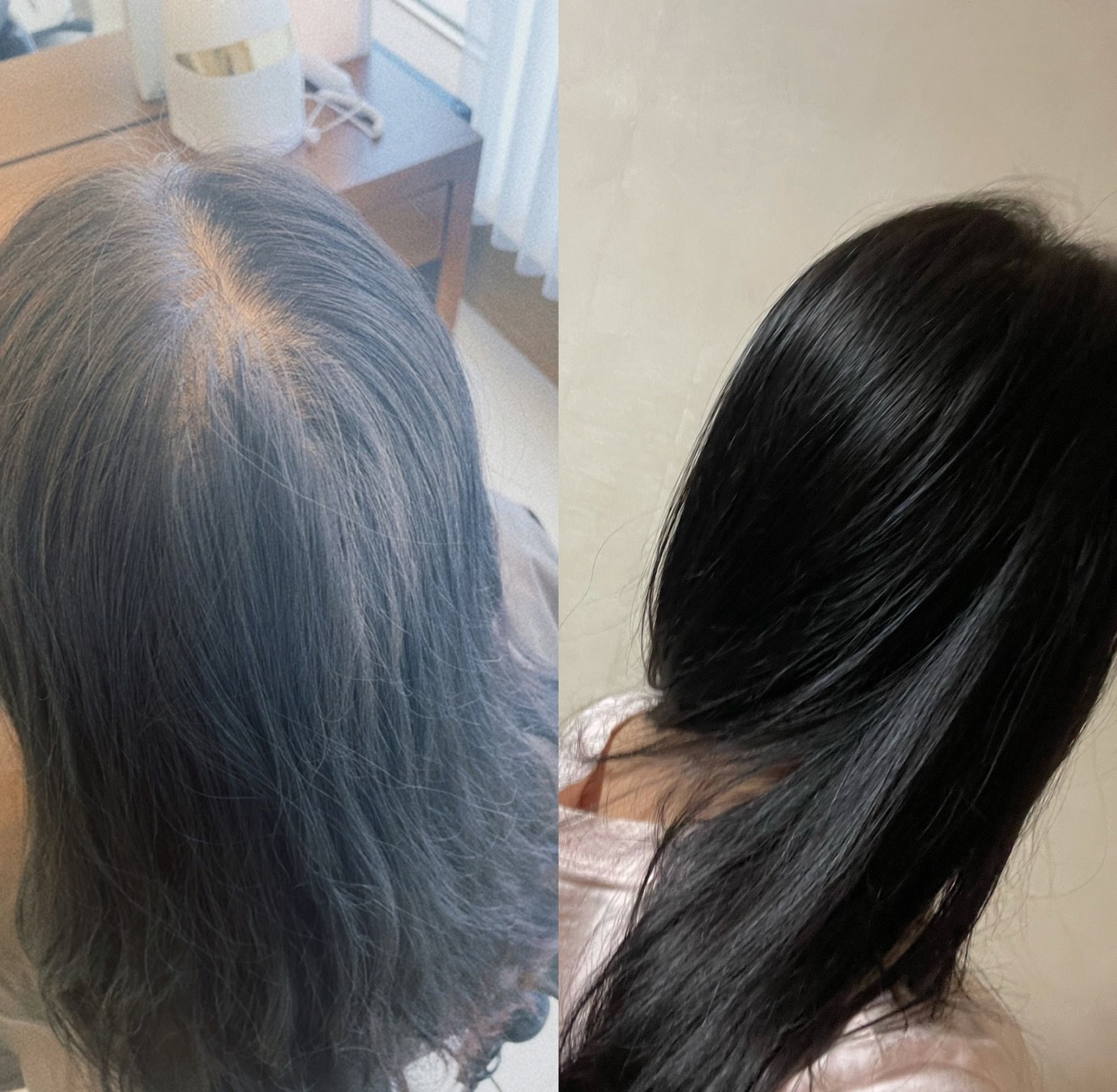  20대여성탈모 8년만에 머리난방법 및 각종 탈모치료 후기