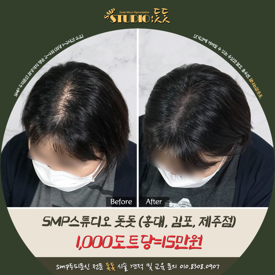  의정부 두피문신 여자 정수리 탈모 커버