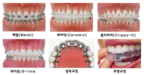 교정 장치 사진