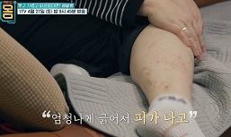 만성콩팥병