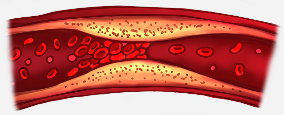 고지혈증에 좋은 음식 총 정리 1