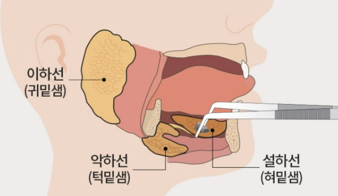 타석증이란&amp;#44; 타석증 증상 수술 치료&amp;#44; 수술입원기간 알아보기(최신) 