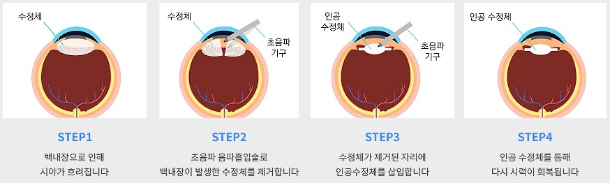 백내장 치료법