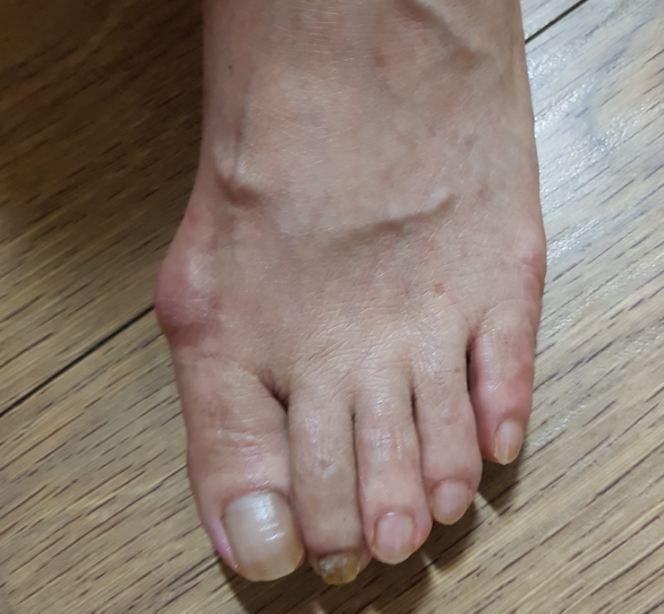  무지외반증 교정 방법