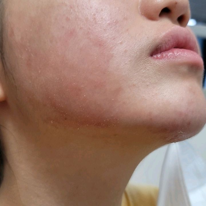 갑자기 생기는 성인아토피