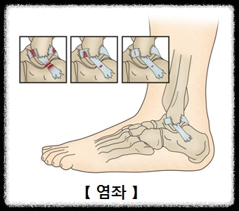 염좌