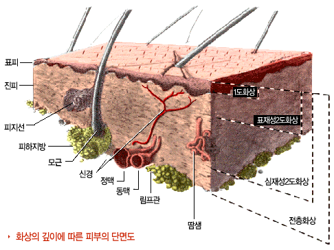 화상 단면도