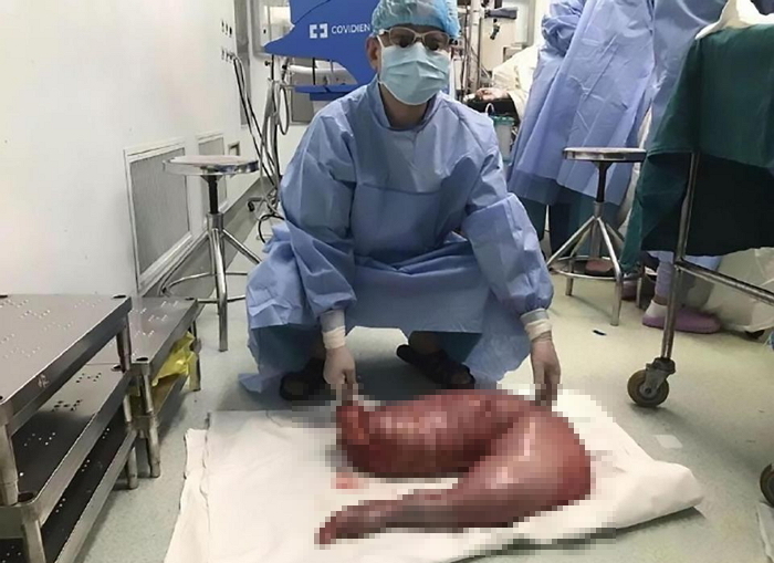 22년 동안 만성 변비로 고통받던 남성, 뱃속에서 발견된 충격적인 정체에 의사가 깜짝 놀란 이유