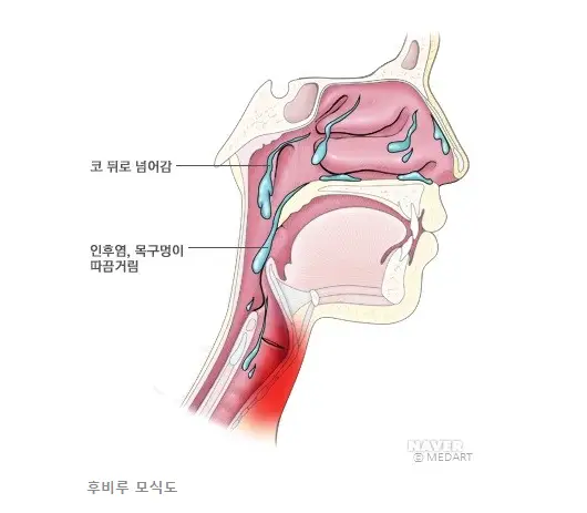 후비루 모식도. 사람 옆 얼굴의 단면도가 그려져 있고 곳곳에 가래가 흐르고 있는 그림. 코 뒷 부분에 가래 그림이 그려져 있고 &#39;코 뒤로 넘어감&#39; 이라는 코멘트가 쓰여 있고 목구멍에도 가래가 흐르는데 &#39;인후염&#44; 목구멍이 따끔거림.&#39; 이라는 코멘트가 쓰여 있다.