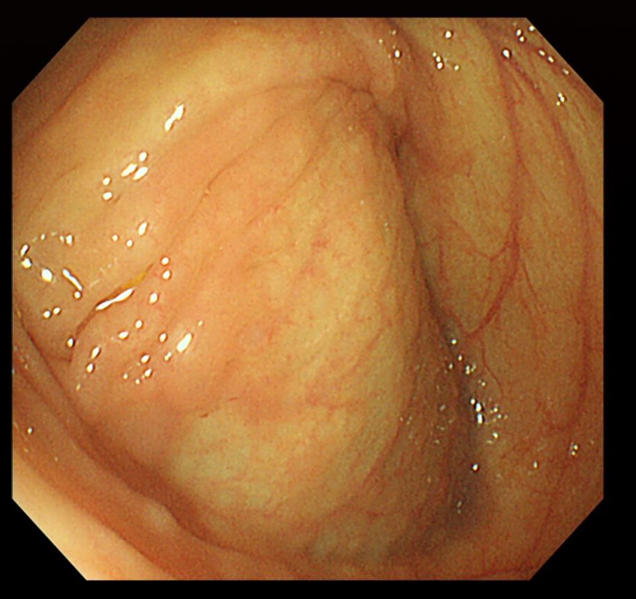  건강 보험 무료 암 검진 대장암검진-대장내시경 주의사항/결과