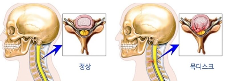  목디스크 증상 7가지