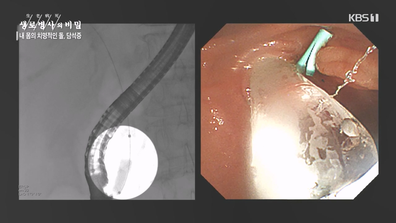 생로병사의 비밀.E886.231019p-NEXT.mp4_20231019_203446.215.jpg