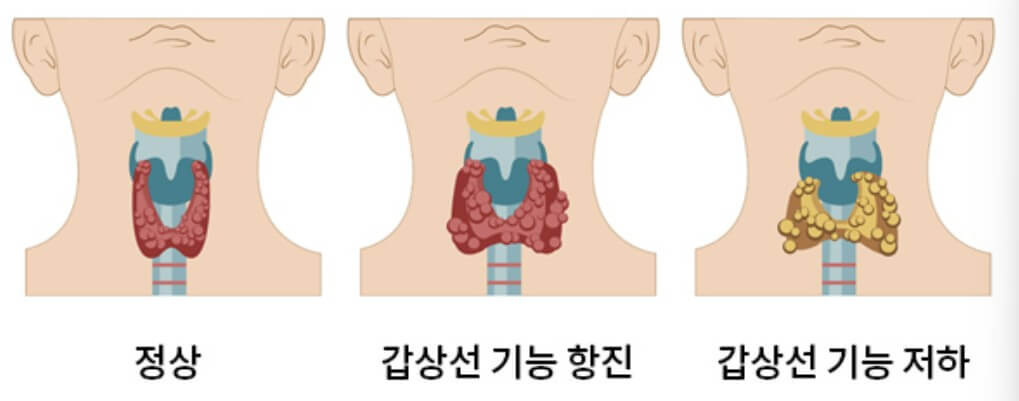 갑상선 기능 저하증 (4)