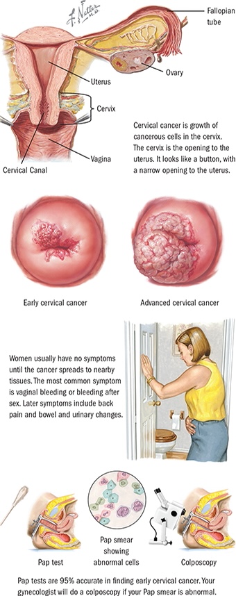 자궁-경부암