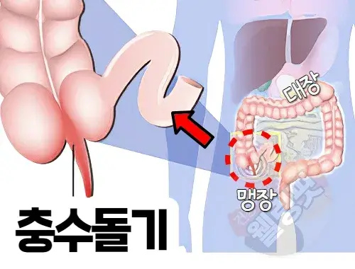 오른쪽-옆구리에-위치한-충수돌기