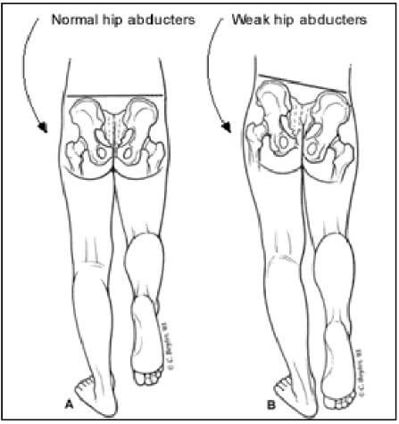 보행 시 고관절 외전근이 정상 상태일 때 골반이 빠지지 않고 비정상 상태 일 때 골반이 빠지는 그림