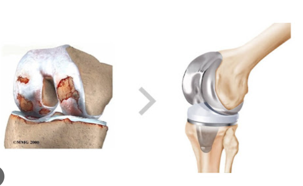 인공관절 수술의 필요성