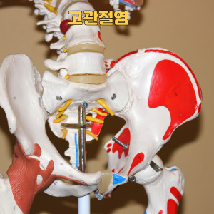 대퇴골두 무혈성 괴사