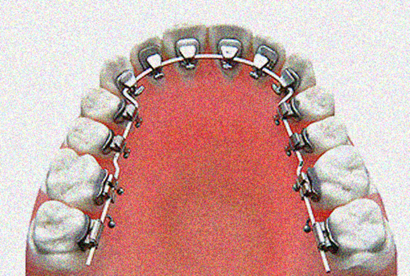 설측 교정기 (Lingual Braces)