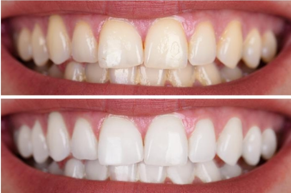 누런 치아 하얗게 만드는 가장 간단한 3가지 방법