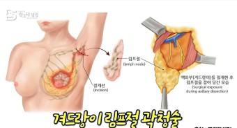 겨드랑이 림프절 곽청술 사진