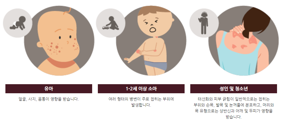 아토피피부염 주요증상