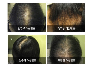 여성 탈모