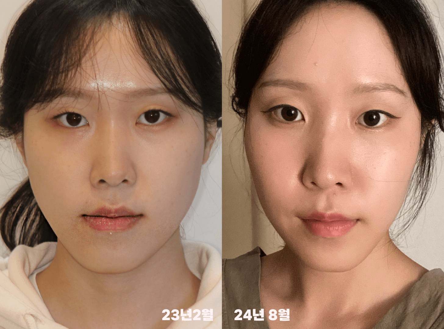 비수술-안면비대칭-교정