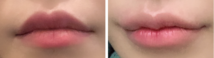  입꼬리보톡스 후기, 입꼬리필러 후기(솔직히 이럴줄 몰랐음)