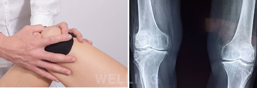 무릎연골 손상증상 원인 예방법