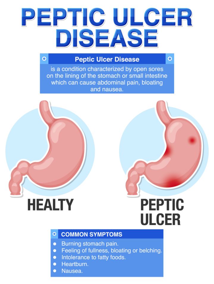  위궤양 (Peptic ulcer): 주요 증상, 좋은 음식, 식이 요법