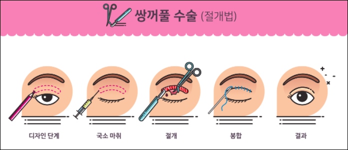 쌍꺼풀 수술 비용 방법 후관리 회복기간