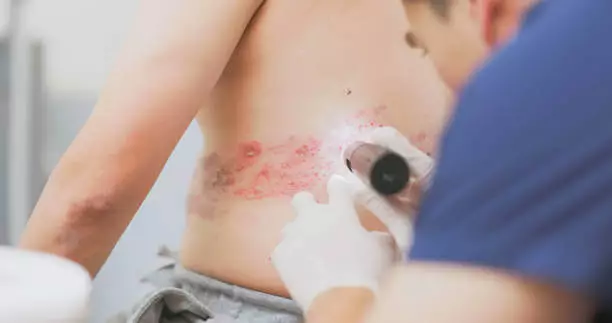 대상포진 초기증상 치료방법
