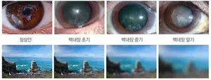  백내장 눈 안쪽이 하얗게 변하는 장애라는 뜻