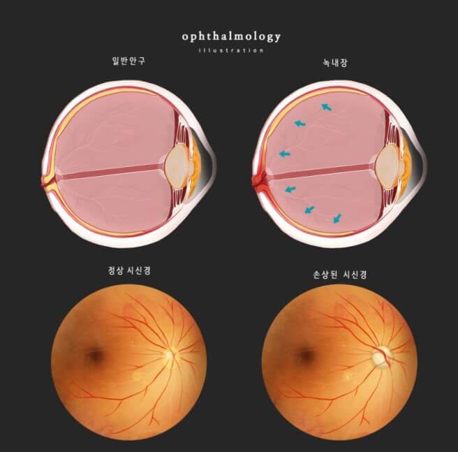 녹내장 증상