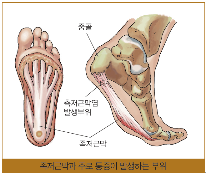 족저근막염의 증상