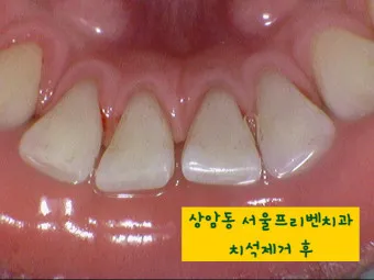 스케일링 후 양치 통증 음식_12
