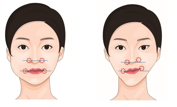  [성형부작용 완벽타파] 안면윤곽수술 후 비대칭·볼패임 등 이상증상 해결법