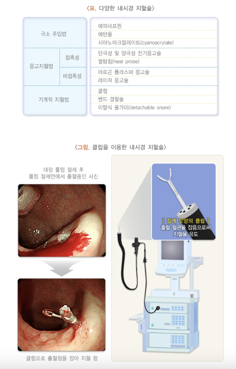 내시경 지혈술