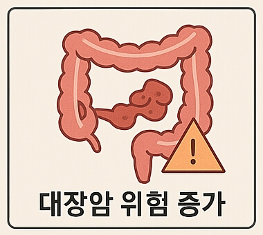 대장암