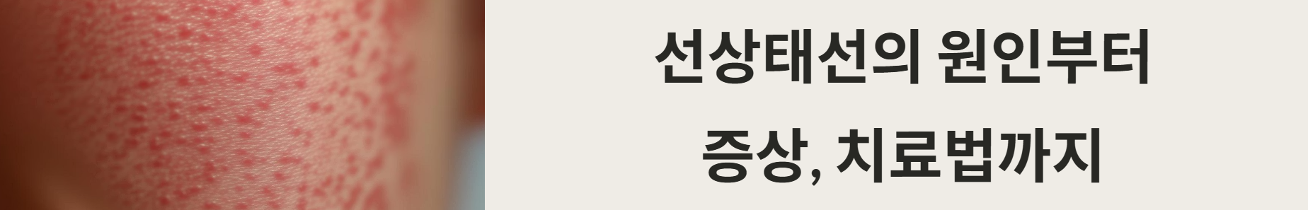선상태선의 원인부터 증상, 치료법까지